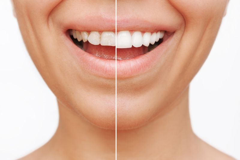 Are Veneers Permanent? Everything You Should Know Before Treatment