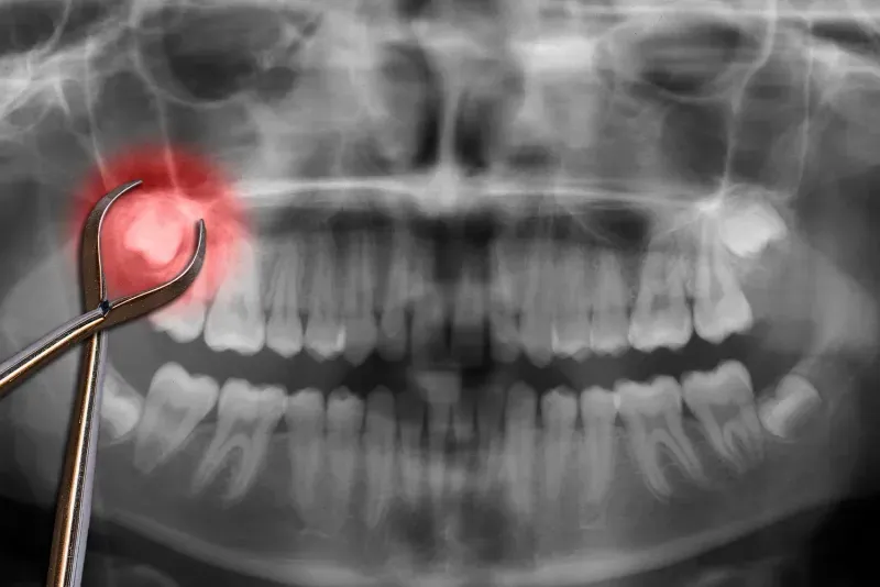 Can I Go to Work the Next Day After Wisdom Tooth Extraction?