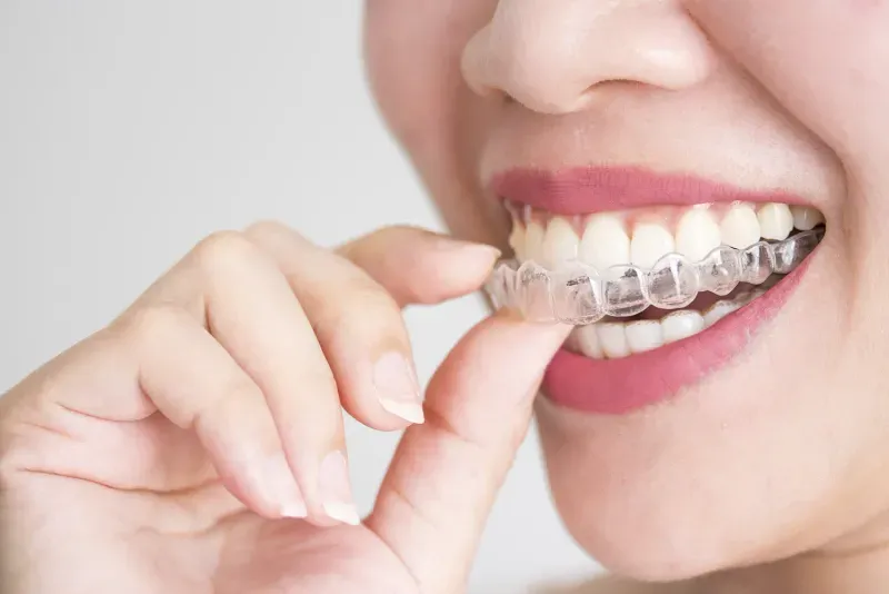 Can You Wear a Mouthguard With Invisalign?