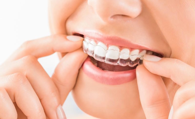 How To Clean Invisalign Trays – Everything You Need To Know About Aligner Care