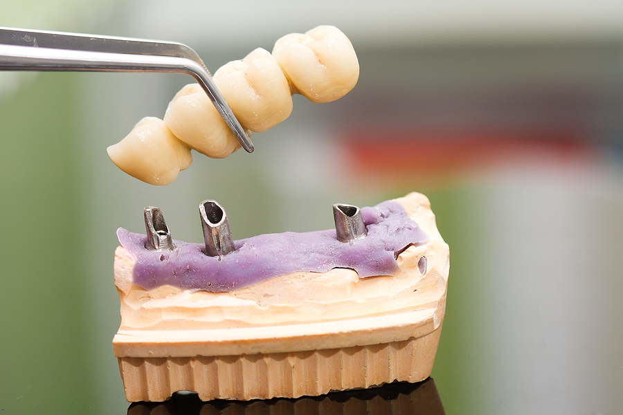 Restoring Your Smile with Dental Bridges in Portland, OR