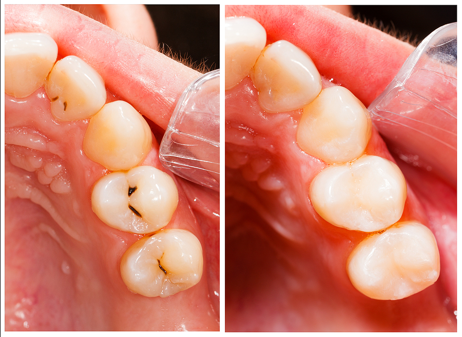 Everything You Need to Know About Dental Fillings in Portland, OR