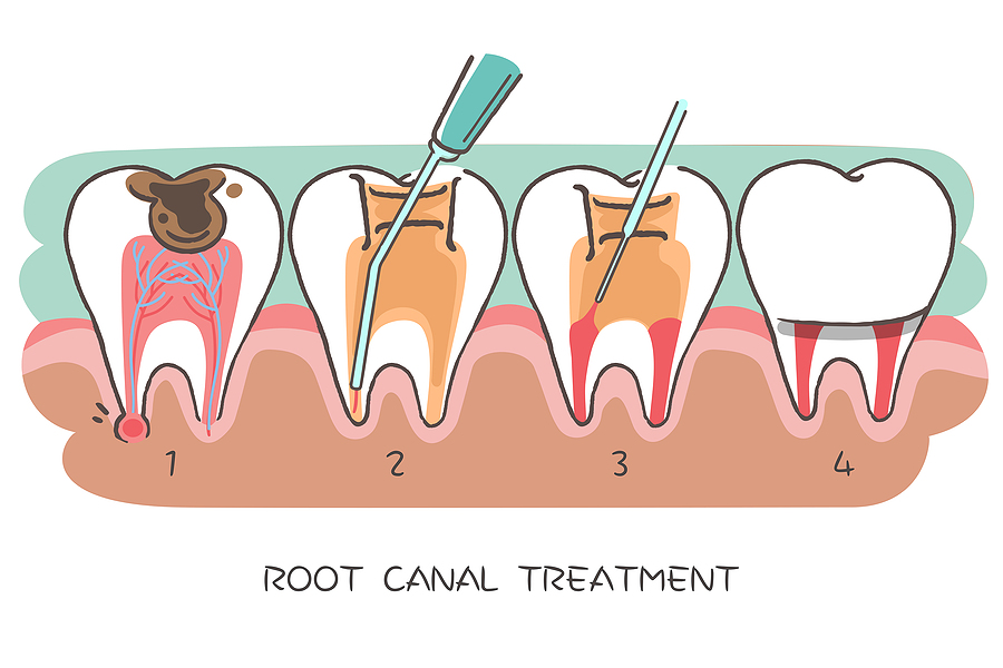 Understanding Root Canal Treatment: A Lifesaver for Your Smile