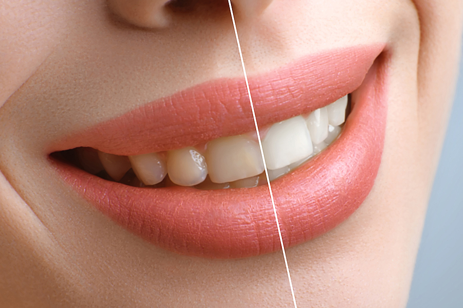 Achieve a Brighter Smile with Teeth Whitening in Portland, OR