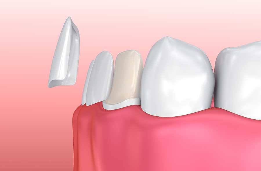 Transform Your Smile with Veneers in Portland, OR